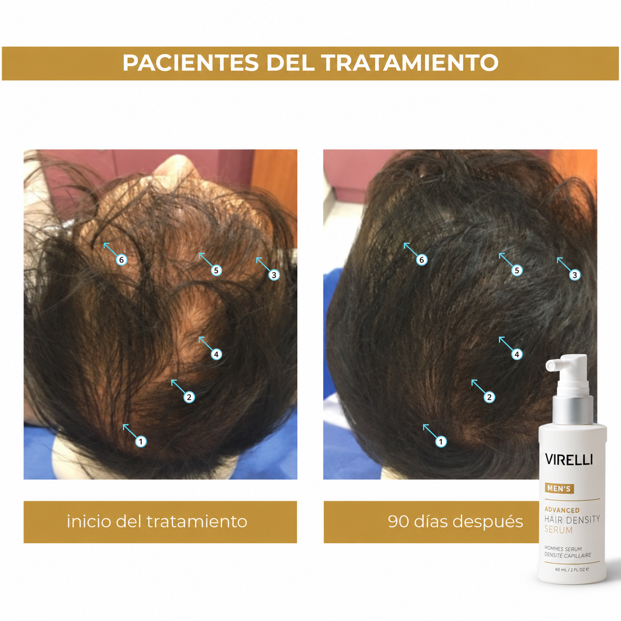 Nanoxidil Men's® Loción Capilar Virelli
