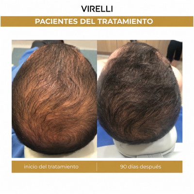 Nanoxidil Men's® Loción Capilar Virelli